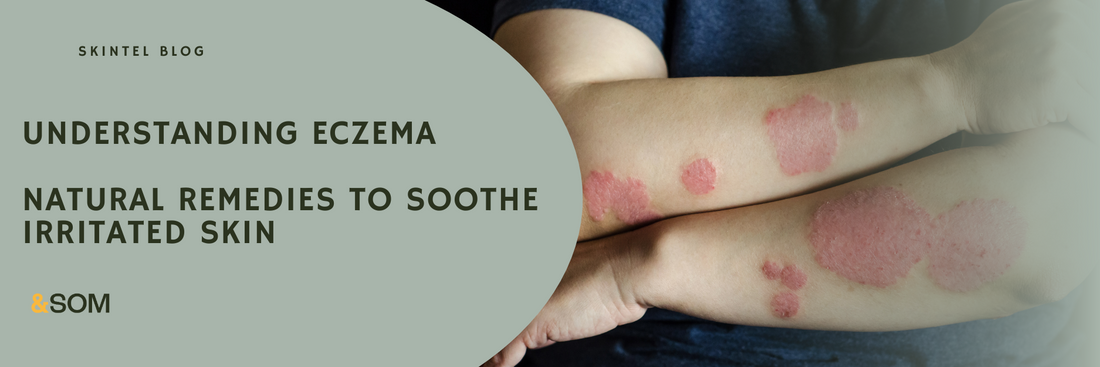 Natural Remedies for Eczema