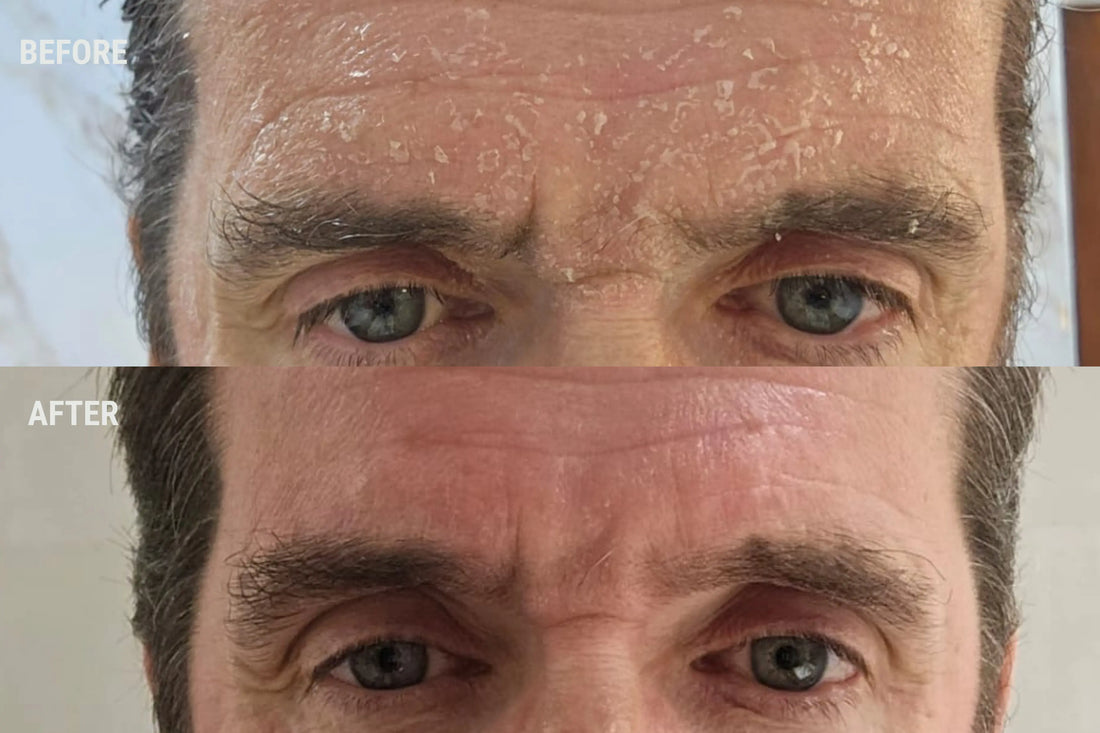 The Best Skincare Routine for Men with Dry Skin