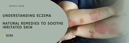 Understanding Eczema and Natural Remedies to Soothe Irritated Skin (DO NOT USE BLEACH!)