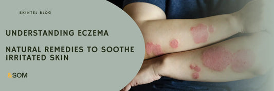 Natural Remedies for Eczema